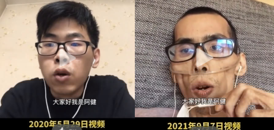 结直肠癌|34岁抗癌博主阿健离世,结直肠癌发病人数逐年攀升!要怎么防?