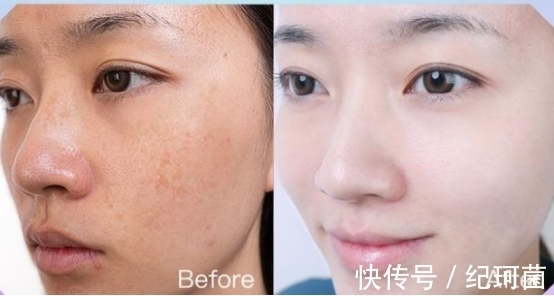 黄褐斑|大牌祛斑产品哪款最有效果?全球公认最好的祛斑产品抢先看~