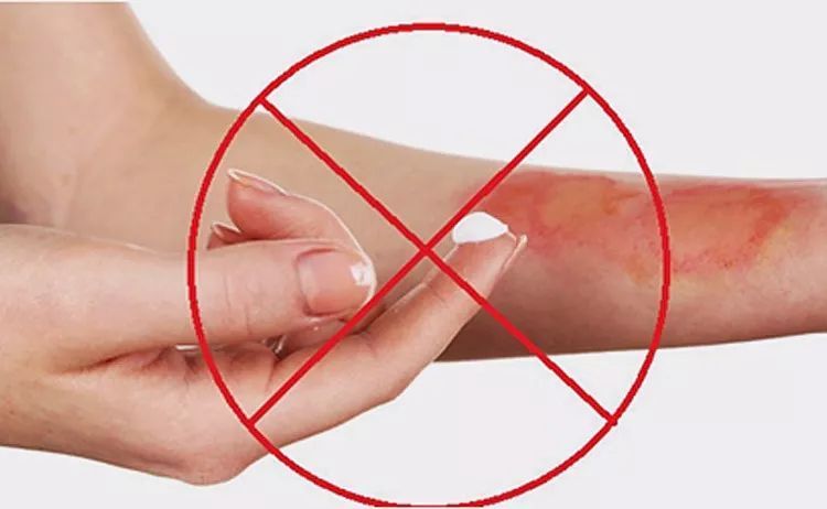 水泡|烧伤烫伤怎么办？潍坊市中医院这份口诀要记牢