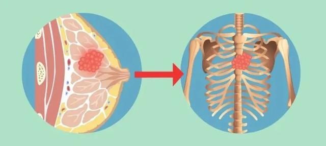 浙大一院|宁信偏方不信医生，58岁舟山大姐乳腺癌发生骨转移！这些“坑”本可避免