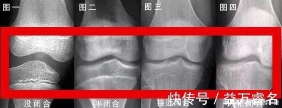 身高|孩子停止长高的几个迹象,若其中一个提前出现,当心伴随着性早熟