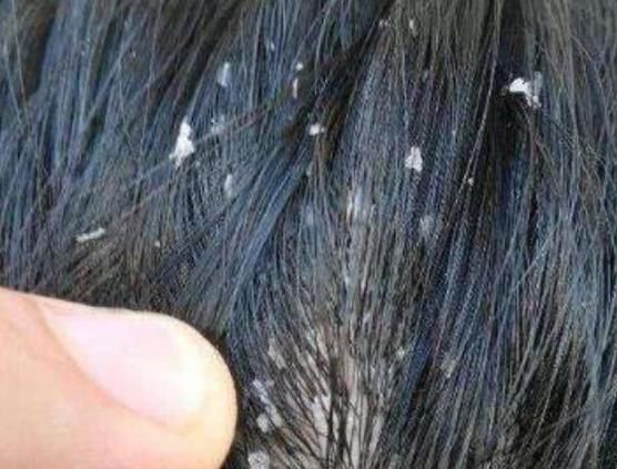 洗发水|头发多久洗一次最健康村口托尼超过这数,难怪头发越洗越油