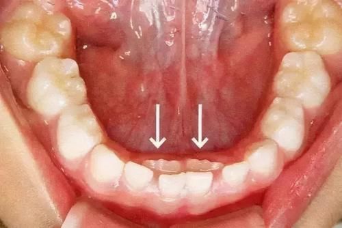 堆堆|孩子乳牙没掉，新牙就已长出？造成孩子乳牙脱落晚的原因不止一种