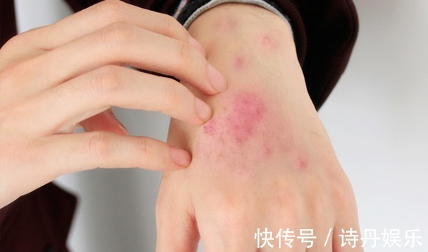 黑棘皮|血糖太高,皮肤不会说谎,皮肤出现以下表现,或是糖尿病找上门了