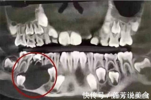 生活质量|5岁男孩的牙齿全部烂掉,医生训斥无知,妈妈没想到这么严重
