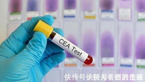 结直肠癌|癌胚抗原与哪种癌症关系密切？升高多少与病情严重程度有关系吗？