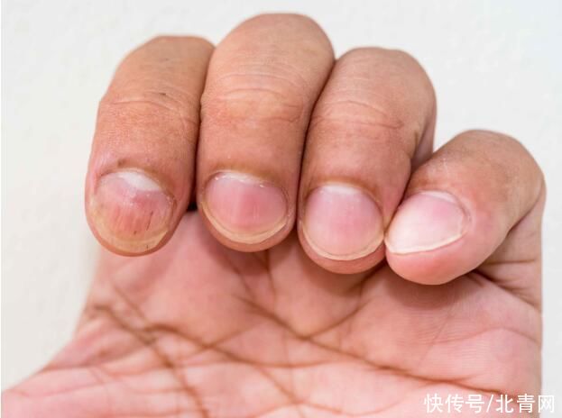 肺部发生癌变时，手上会出现3种迹象