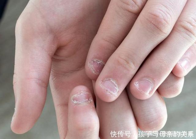 堵不堵|血管堵不堵,看手就知道!若手上出现4个异常,当心血栓“扎根”