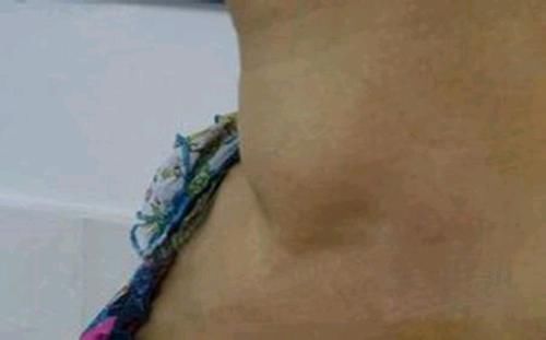 肝气郁结|甲状腺为何会出现结节?4件事或许是主因,希望能够及时改正