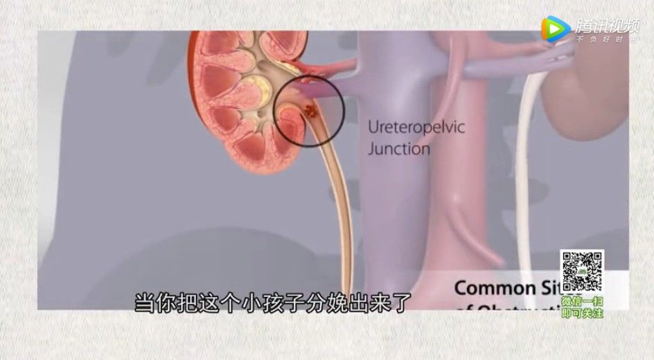 器官|这种隐藏在身体里的小石头是“沉默的杀手”，不痛不痒却能破坏整个器官！