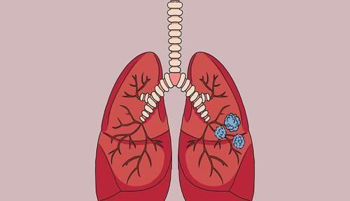  解答|结节、息肉、囊肿，哪个才是癌症“前身”？听听医生全面解答