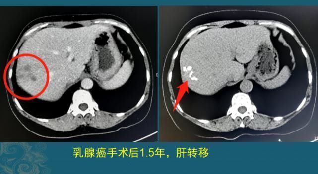 病人|查出癌症不放疗不化疗，保持良好心态吃喝玩乐，能扛过去吗