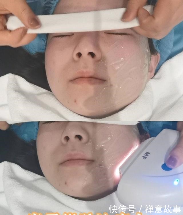 仪器 医美界的万金油,光子嫩肤探店!