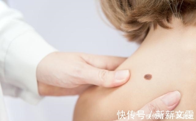 斑痣|身上长这2种痣时，需引起重视，以免危害健康