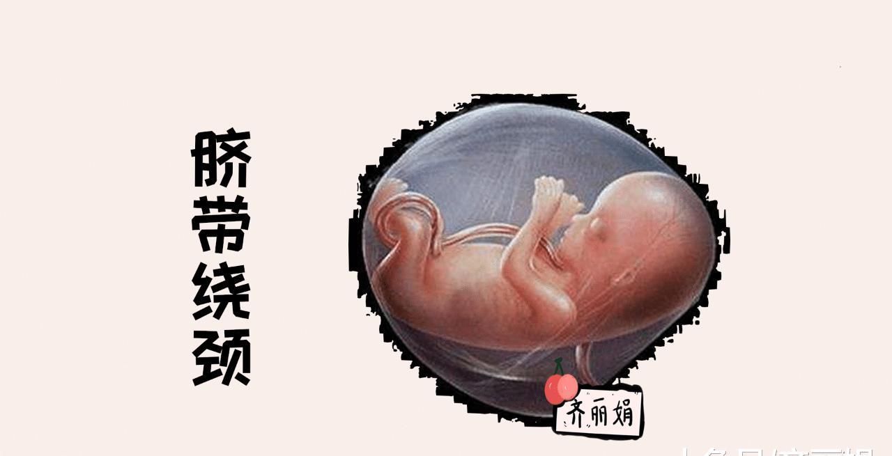 信号|宝宝脐带绕颈时会发出“求救信号”, 孕妈要格外关注胎儿变化
