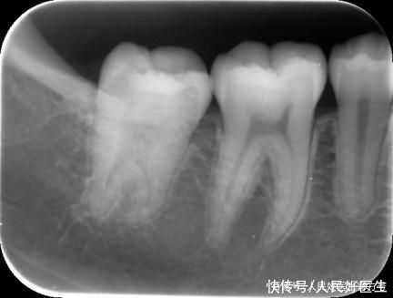 治疗|“看个牙还要拍个X光吃个线?”