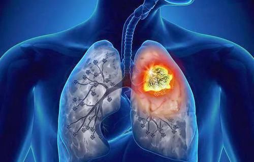 肺部|5物是肺部“天然清洁工”,平时敞开吃,助你排毒清肺一身轻