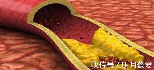 大蒜|高血脂的“天然药”发现了，每天吃一点，清血管，血脂噌噌下降