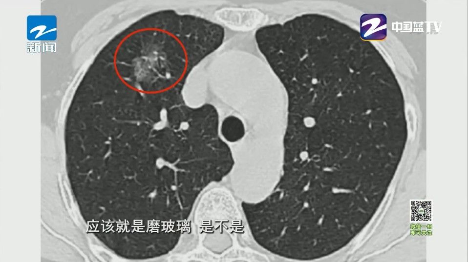 实性|这样的肺结节竟是癌前预告 你们的肺需要好好保护