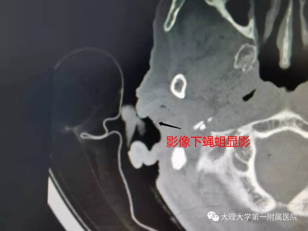 医生|头皮发麻！老人总是耳朵疼，医生一看：20条…