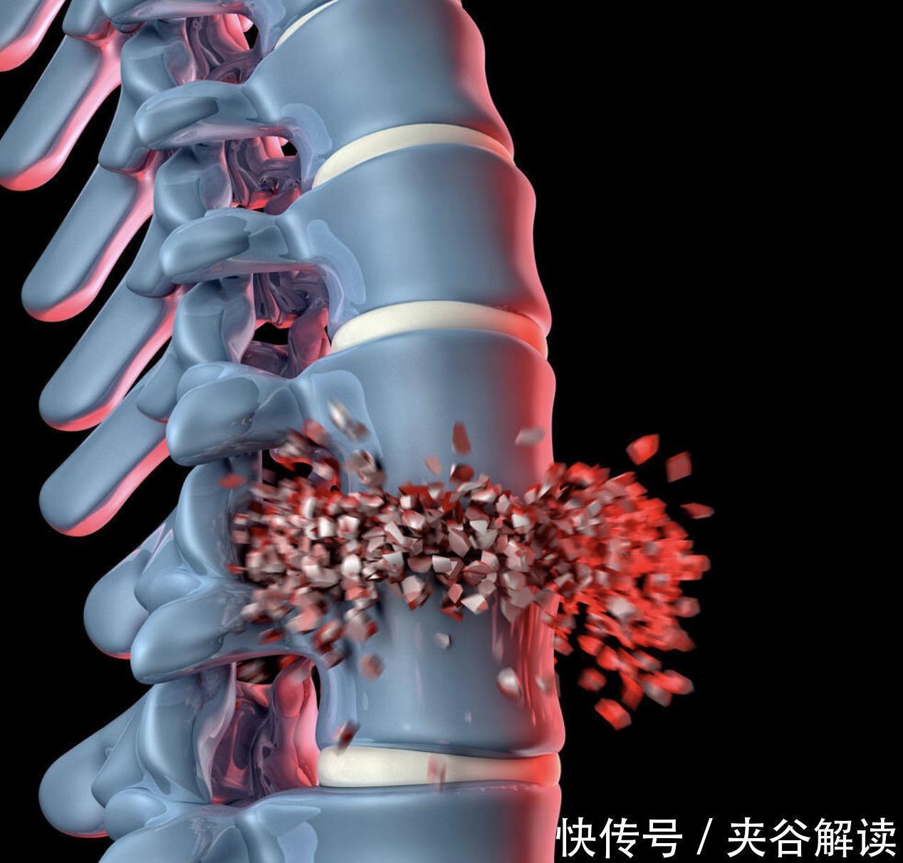 骨刺|医生公开这“三类”疾病都不算病，即使人老了也无需过度治疗