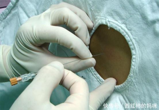 后遗症|做剖腹产打麻醉，以后会对腰有影响吗？