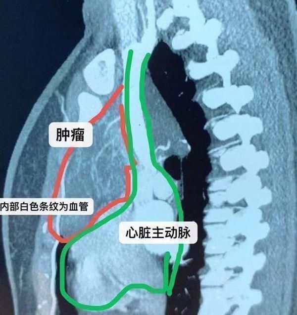 纵隔|32岁年轻妈妈前纵隔发现巨大肿瘤，手术风险高，要不要做