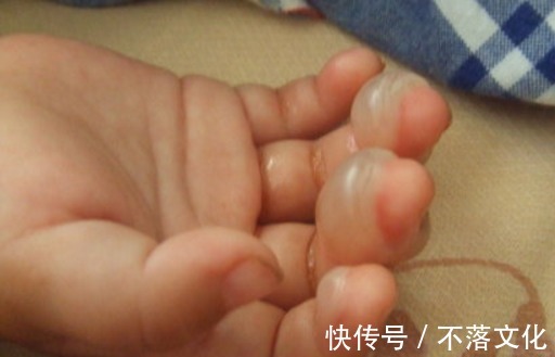 伤处|5岁孙子被开水烫伤,奶奶临危不乱及时处理,获医生称赞 !