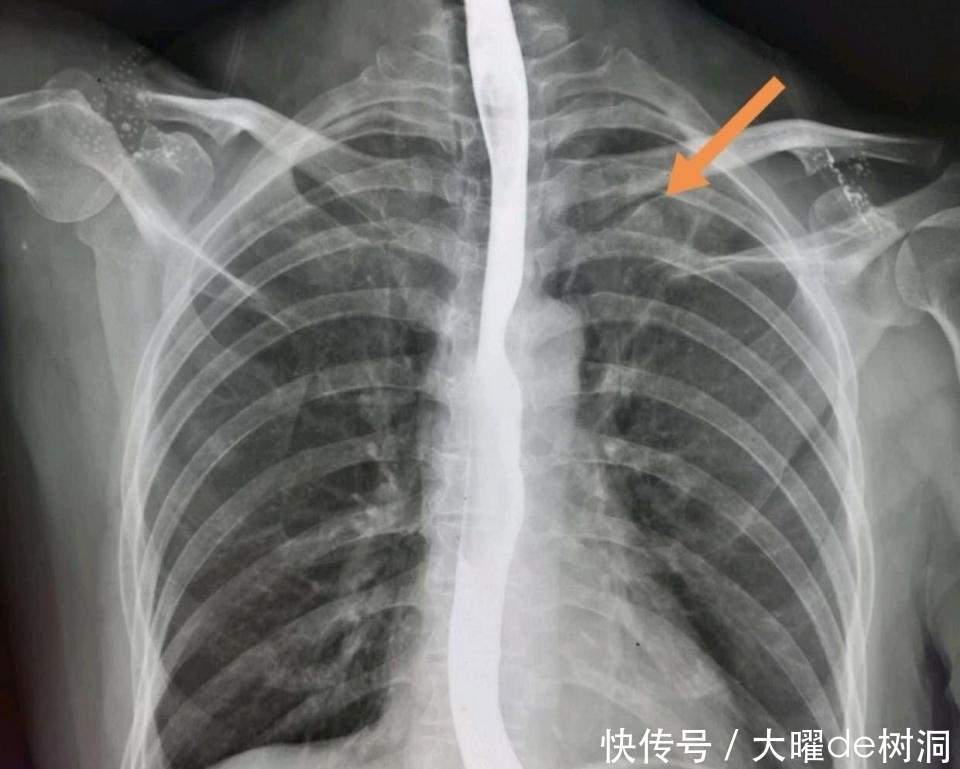 年年体检,为什么还得了晚期肺癌?体检有啥用!