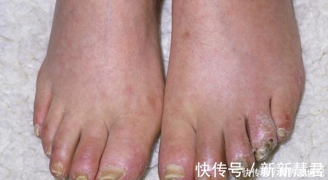 尿毒症|接连感冒被查出尿毒症,肾病早期会有4个“求救”信号,不妨一看