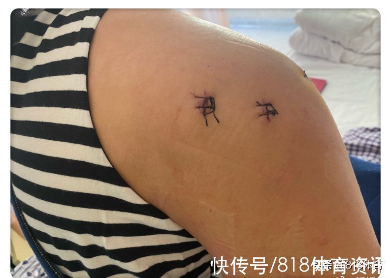 手术|泪目!女排北长城颜妮6个半小时手术报平安,修复右肩成功打8颗钢钉