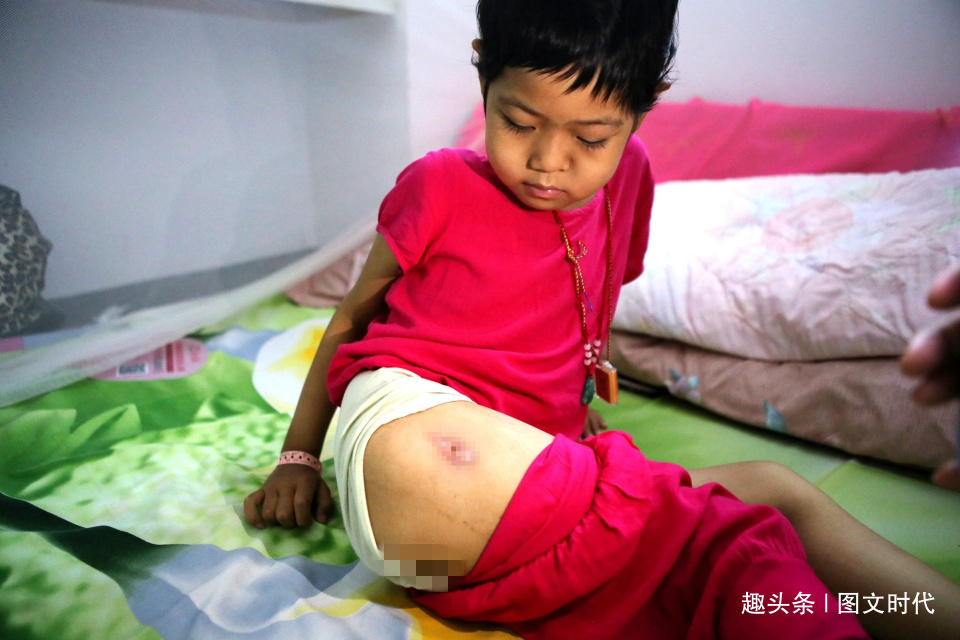 程程|6岁女童鼻子突然红肿,送医查出罕见肿瘤,妈妈含泪打掉腹中胎儿