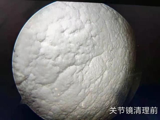 尿酸|尿酸高达856，关节里磨出石灰膏！医生：“这是我从医以来，见过的尿酸最高的患者”