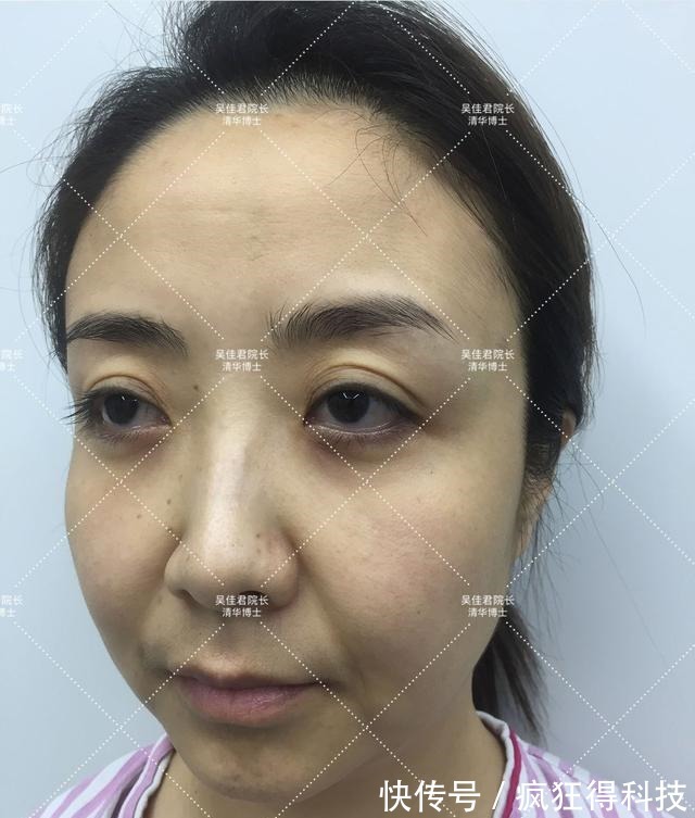 面部 小拉皮术后8个月,她从松垮阿姨脸秒变紧致少女脸!