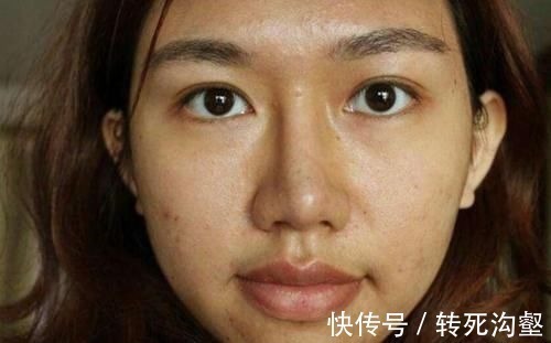 荨麻疹样|4块钱的红霉素软膏成了淡斑专家,营养师,用法和真相要明白