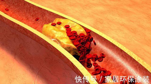 血管健康|高血脂不能喝牛奶吗?医生:想稳定甘油三酯,2种食物尽量少吃