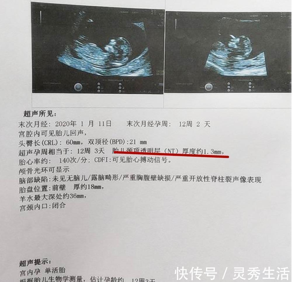 b超|怀孕期间，产检时4种结果“异常”，可能是胎儿智力出现问题了