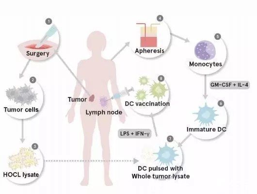 免疫细胞|重磅抗癌疫苗又获新突破,一名晚期癌症患者,5年无复发