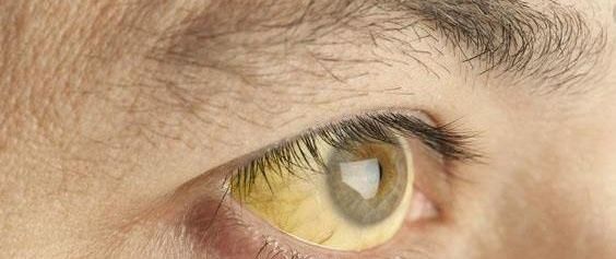 肝癌|身体两处“发痒”，别误以为过敏了，又可能是肝癌的征兆!