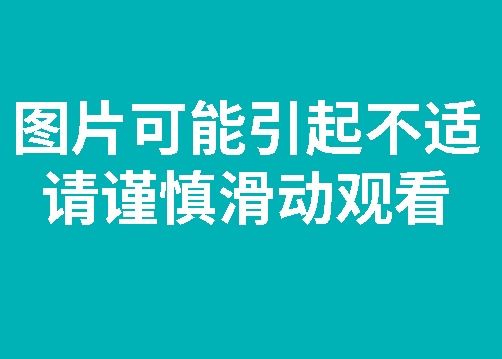  文先生|头皮发麻！男子体内惊现大量“瓜子”活虫...取出来还在动！