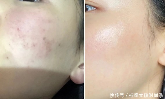 产品|拒绝踩雷!5款祛痘印热门产品,最好用的竟然是它!值得回购N次