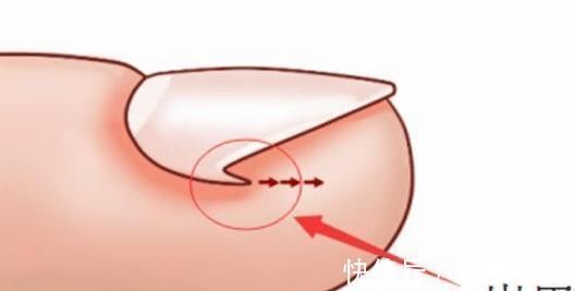 遗传病|脚指甲长进肉里教你一个“土办法”治疗，不用看医生