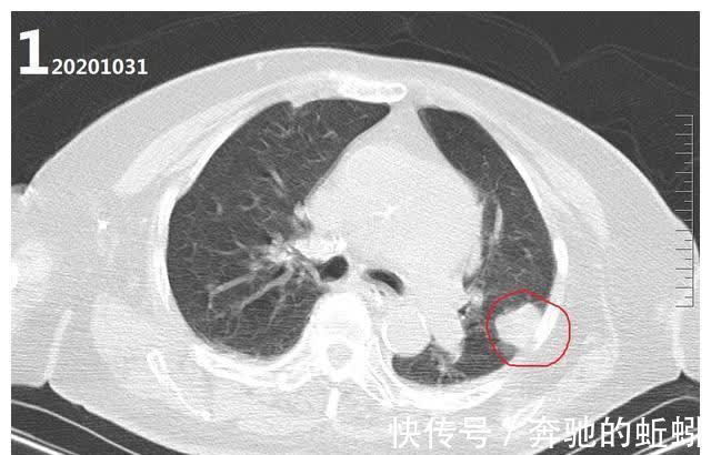 ct|如果不治疗的话,肺癌的发展速度到底有多快?