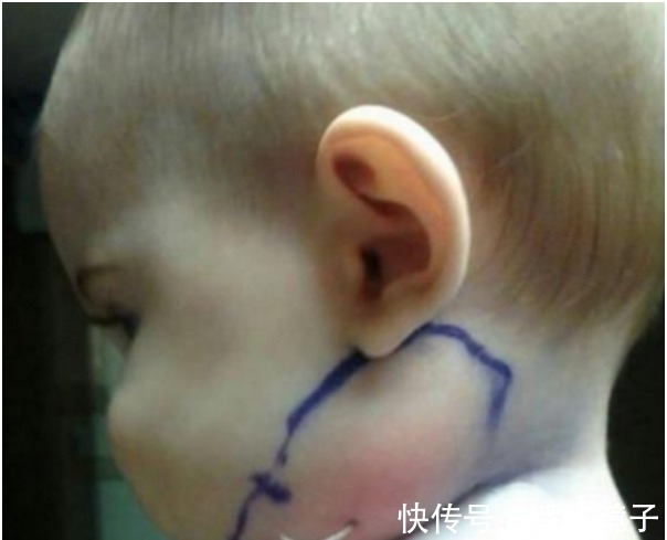 红肿|父母带着脖子突出一根东西的女婴去医院 一往外拉连医生都吓傻