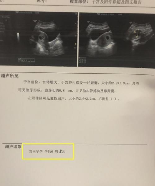 孕妈|医生确定预产期:即使孕妈生理周期不规律,也能精准判断