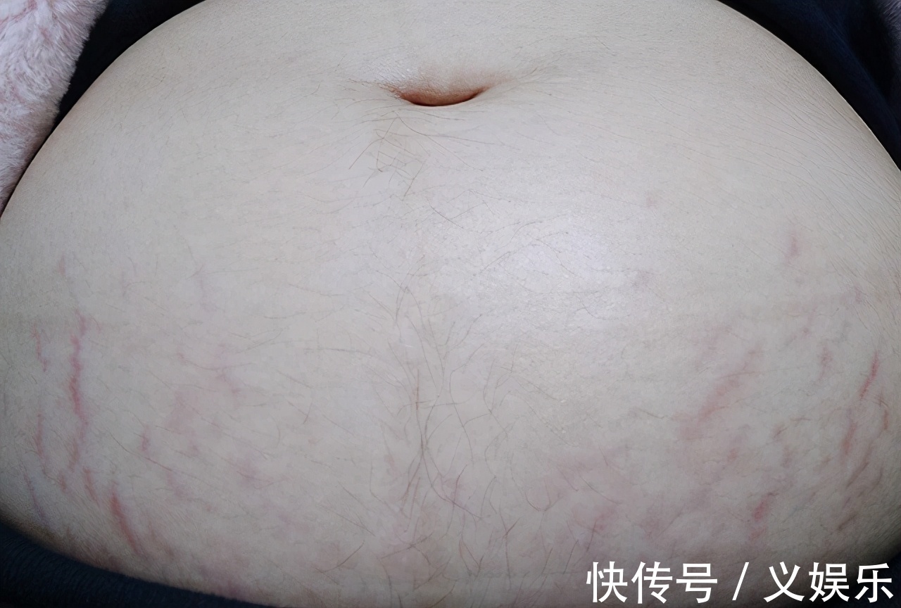 孕妈|怀孕后,为啥有人会长妊娠纹,有人却不会长和这四个因素有关