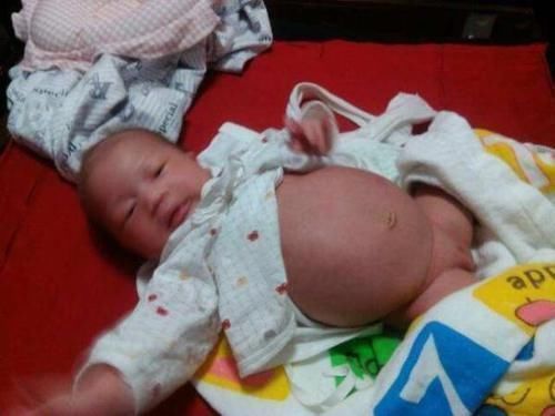 怀孕|6个月女宝肚子胀得像怀孕,家人赶紧送医院,医生:还好来得及时