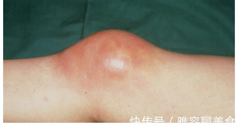 仙人掌|一块仙人掌胜过百副药，膝盖不疼了，积液也消了，滑膜炎不攻自破