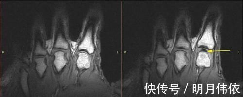 指关节|掰手指发出“咔咔”响声时，你的关节里究竟发生了什么