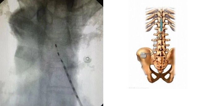 检查|广东一男子身上“生蛇”，检查结果惊出冷汗！医生紧急提醒